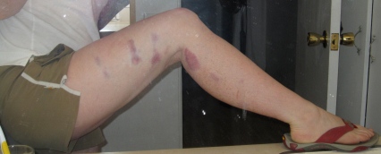 A thigh covered in bruises